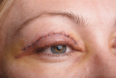 woman_with_less_blepharoplasty_swellingwoman_with_less_blepharoplasty_swellingwoman_with_less_blepharoplasty_swellingwoman_with_less_blepharoplasty_swellingwoman_with_less_blepharoplasty_swellingwoman_with_less_blepharoplasty_swellingwoman_with_less_blepharoplasty_swellingwoman_with_less_blepharoplasty_swellingwoman_with_less_blepharoplasty_swellingwoman_with_less_blepharoplasty_swellingwoman_with_less_blepharoplasty_swellingwoman_with_less_blepharoplasty_swellingwoman_with_less_blepharoplasty_swellingwoman_with_less_blepharoplasty_swellingwoman_with_less_blepharoplasty_swellingwoman_with_less_blepharoplasty_swellingwoman_with_less_blepharoplasty_swellingwoman_with_less_blepharoplasty_swellingwoman_with_less_blepharoplasty_swellingwoman_with_less_blepharoplasty_swellingwoman_with_less_blepharoplasty_swellingwoman_with_less_blepharoplasty_swellingwoman_with_less_blepharoplasty_swellingwoman_with_less_blepharoplasty_swellingwoman_with_less_blepharoplasty_swellingwoman_with_less_blepharoplasty_swellingwoman_with_less_blepharoplasty_swellingwoman_with_less_blepharoplasty_swellingwoman_with_less_blepharoplasty_swellingwoman_with_less_blepharoplasty_swellingwoman_with_less_blepharoplasty_swellingwoman_with_less_blepharoplasty_swellingwoman_with_less_blepharoplasty_swellingwoman_with_less_blepharoplasty_swellingwoman_with_less_blepharoplasty_swellingwoman_with_less_blepharoplasty_swellingwoman_with_less_blepharoplasty_swellingwoman_with_less_blepharoplasty_swellingwoman_with_less_blepharoplasty_swellingwoman_with_less_blepharoplasty_swellingwoman_with_less_blepharoplasty_swellingwoman_with_less_blepharoplasty_swellingwoman_with_less_blepharoplasty_swellingwoman_with_less_blepharoplasty_swellingwoman_with_less_blepharoplasty_swellingwoman_with_less_blepharoplasty_swellingwoman_with_less_blepharoplasty_swellingwoman_with_less_blepharoplasty_swellingwoman_with_less_blepharoplasty_swellingwoman_with_less_blepharoplasty_swellingwoman_with_less_blepharoplasty_swellingwoman_with_less_blepharoplasty_swellingwoman_with_less_blepharoplasty_swellingwoman_with_less_blepharoplasty_swellingwoman_with_less_blepharoplasty_swellingwoman_with_less_blepharoplasty_swellingwoman_with_less_blepharoplasty_swellingwoman_with_less_blepharoplasty_swellingwoman_with_less_blepharoplasty_swelling