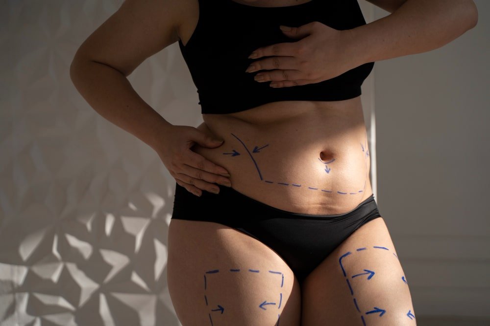 woman_with_marked_body_for_guideline_before_mommy_makeover_in_turkey