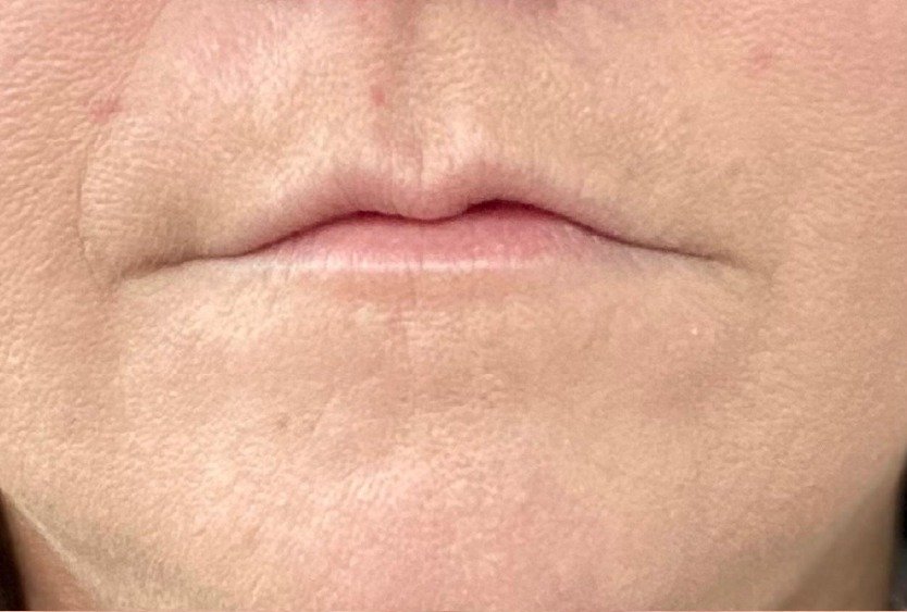 woman_with_thin_lips_before_lip_lift_in_turkey