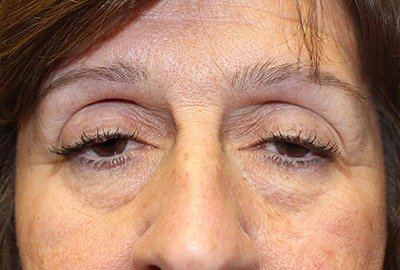 woman_with_tired_appearance_for_fox_eye_lift_in_turkey