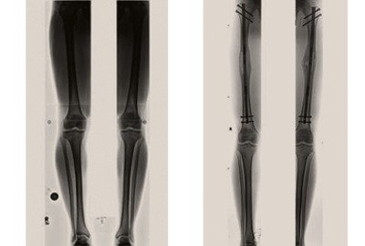 xray_of_precice_limb_lengthening_patient